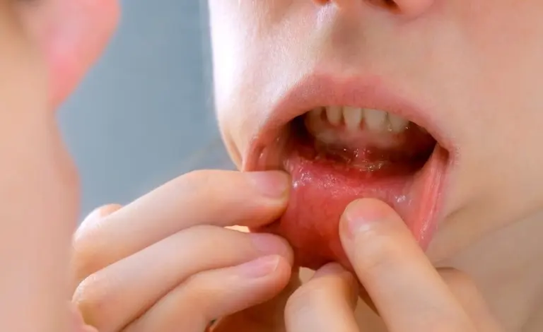 வாய்ப் புற்றுநோய் தொடர்பில் அதிர்ச்சி தகவல்!