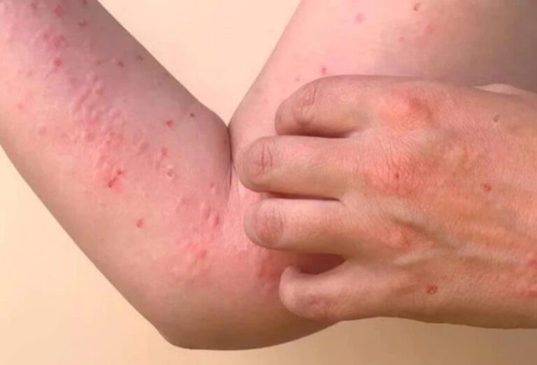 சிக்குன்குனியா குறித்து WHO கடும் எச்சரிக்கை!